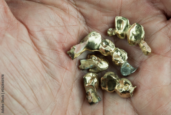 Zahngold, Goldzahn, GvG Pforzheim Goldverwertungsgesellschaft mbh